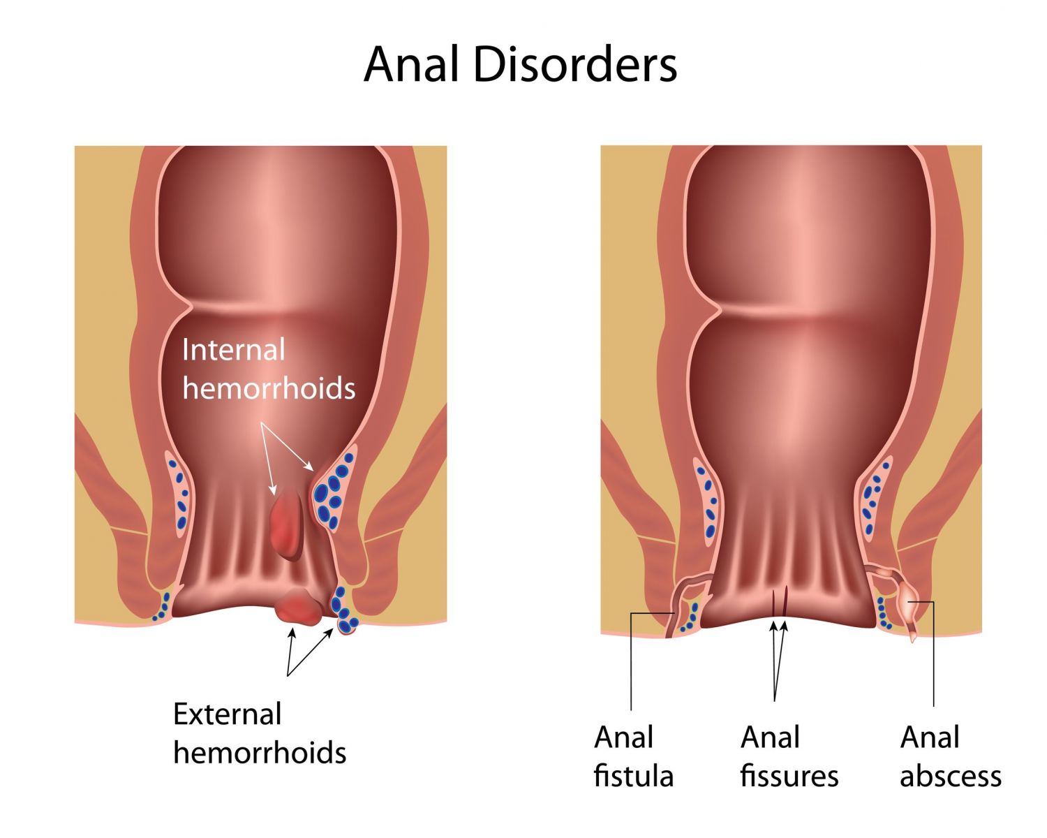 Anal abscess and fistula